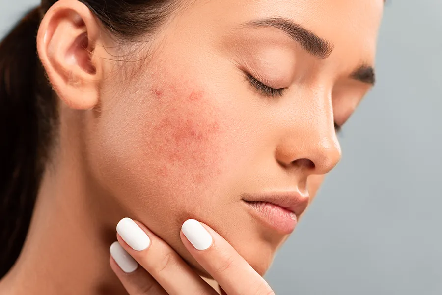 Acne-Clinic Side profile of a woman touching her irritated cheek with visible acne, representing the personalized acne solutions available by Sandra McDonald, NP in Southwestern Ontario.