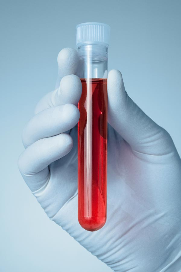 Autoimmune-Treatment Close up of a gloved hand holding a vial of red liquid, representing Sandra McDonald, NP's comprehensive autoimmune disorder treatment in Southwestern Ontario.