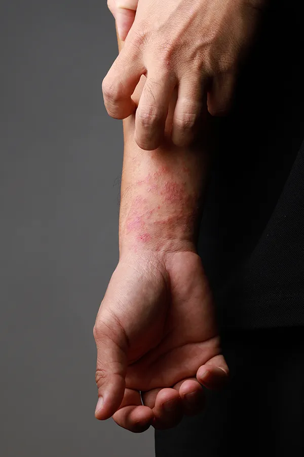 Eczema-Treatment One hand scratches an area irritated by eczema on the other wrist. Get treatment for eczema from Sandra McDonald, NP in Southwestern Ontario.