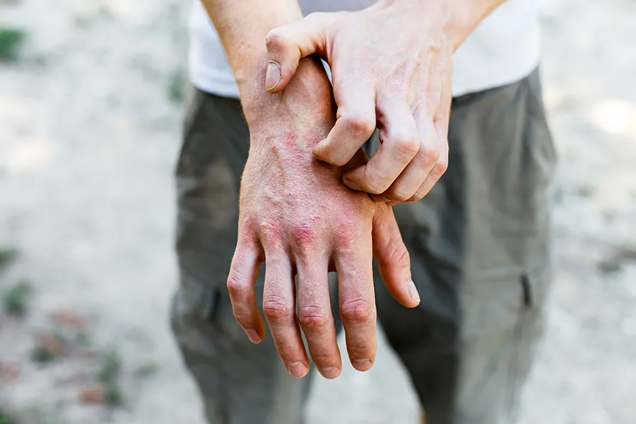 Psoriasis-Clinic Close-up of a man scratching his hands while experiencing Psoriasis. Get care for Psoriasis from Sandra McDonald, NP in Southwestern Ontario.