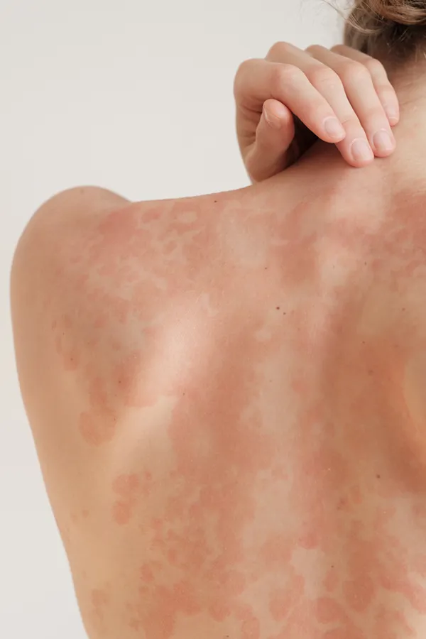 Psoriasis-Treatment The back and shoulder of a woman experiencing Psoriasis. Get treatment for Psoriasis from Sandra McDonald, NP in Southwestern Ontario.