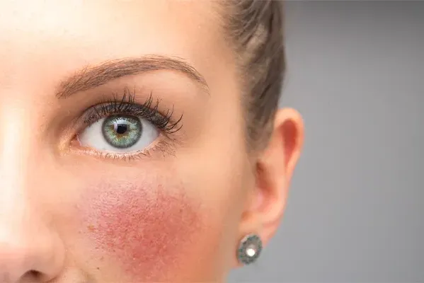Rosacea-Doctor Close-up of a woman with rosacea on her cheeks. Schedule functional medicine treatment for rosacea from Sandra McDonald, NP in Southwestern Ontario.