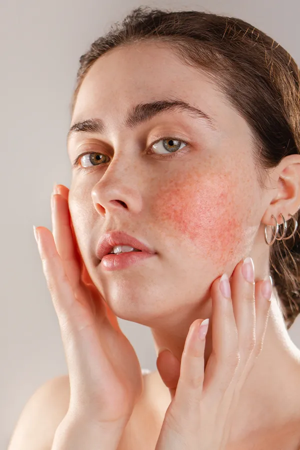 Rosacea-Treatment A women framing her face with her hands while inspecting her Rosacea. Schedule a Functional Medicine consultation for Rosacea by Sandra McDonald, NP in Southwestern Ontario.